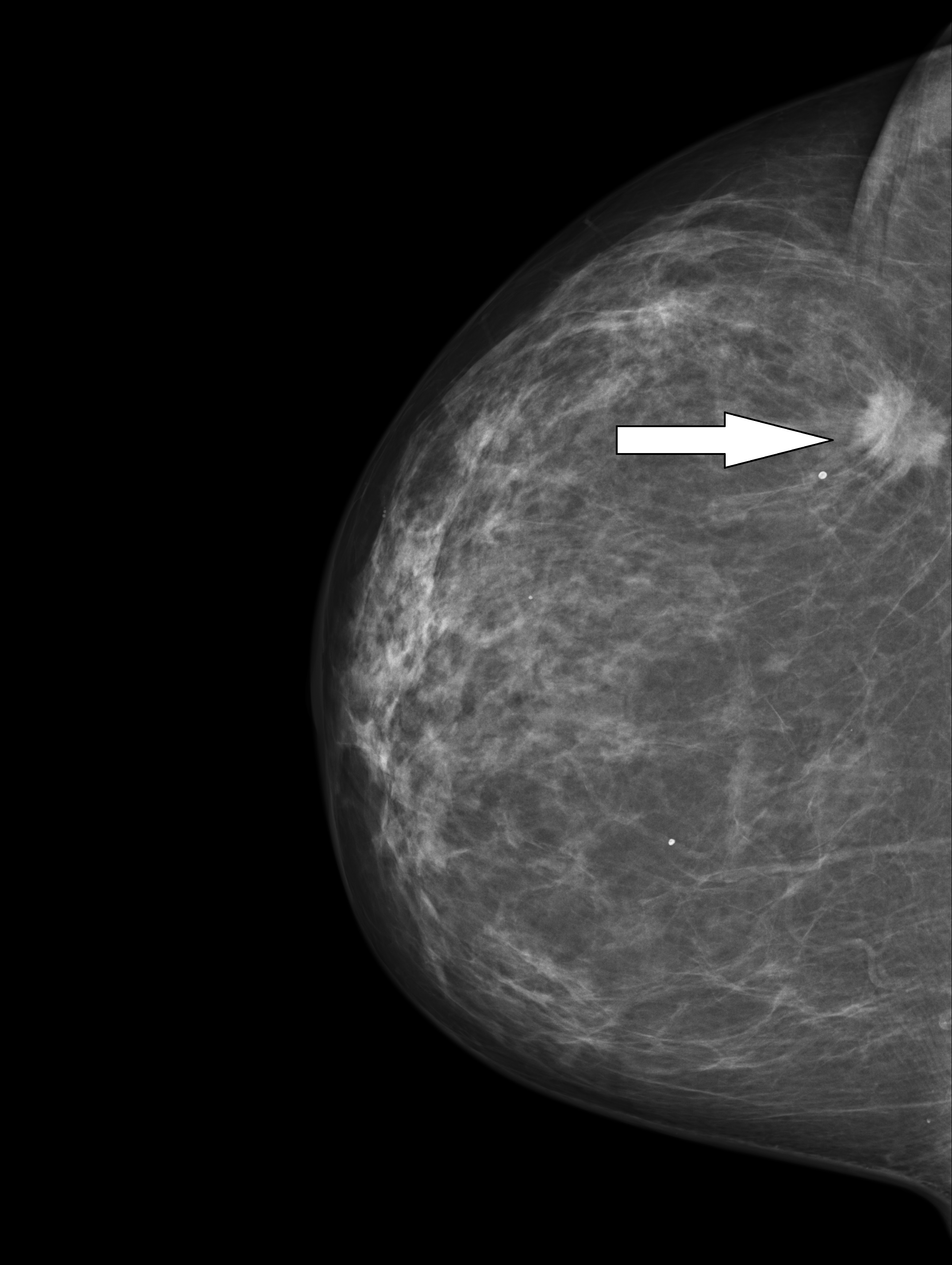 Pacientka č. 1 - Mammogram