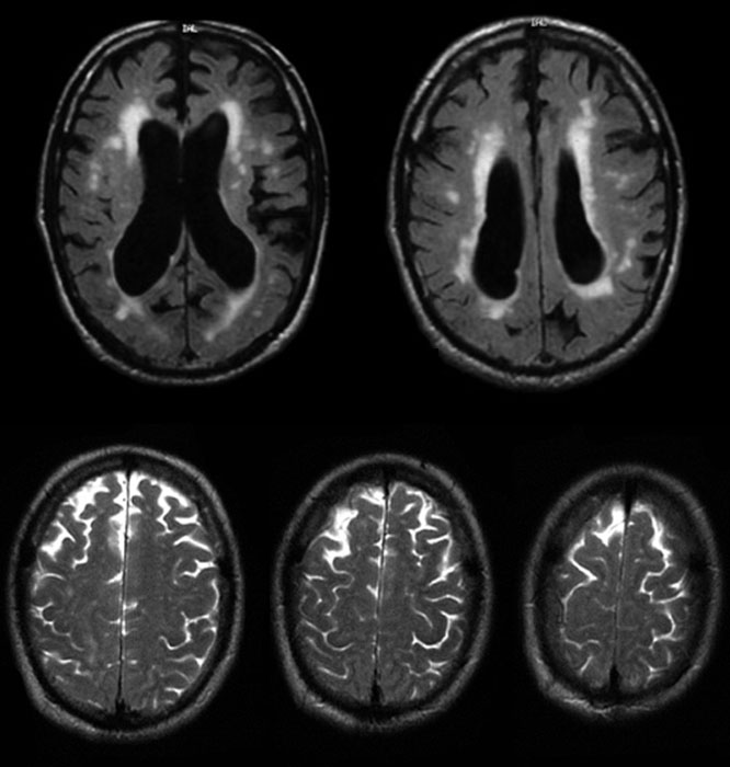 Communicating hydrocephalus with surrounding "atrophy" and increased periventricular and deep white matter signal on fluid-attenuated inversion recovery (FLAIR) sequences. Note that apical cuts (lower row) do not show enlargement of the sulci.