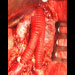 Aneuryzma abdominální aorty