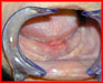 Současný pohled na patogenezi spinocelulárního karcinomu dutiny ústní