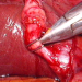 Cholecystektomie laparoskopicky