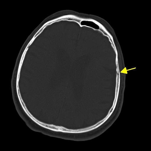 CT kost axiálně - fissura