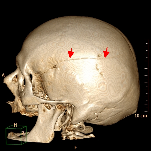 CT 3D VRT - fissura