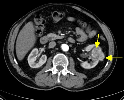 CT arteriální fáze
