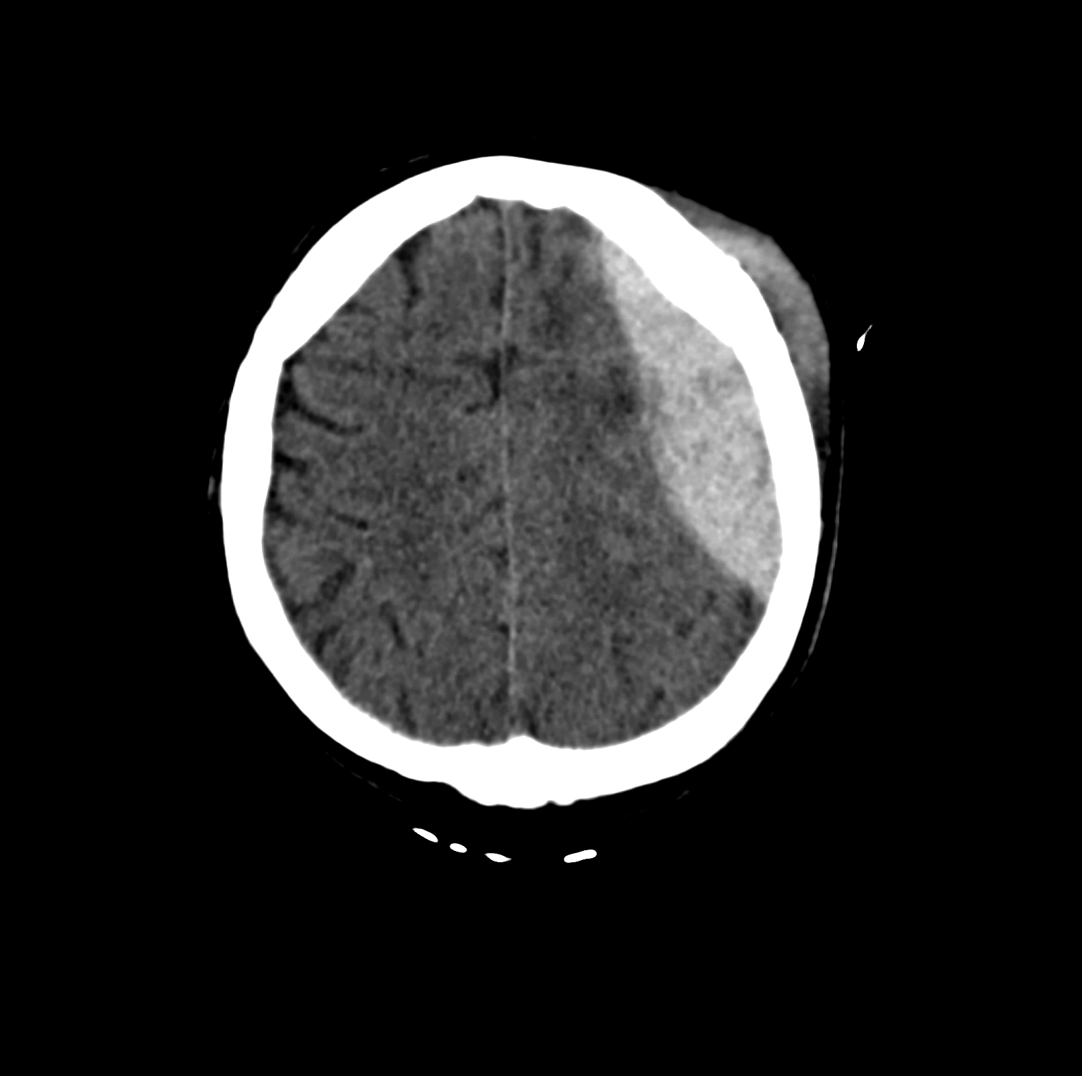 CT axiálně - epidurální hematom