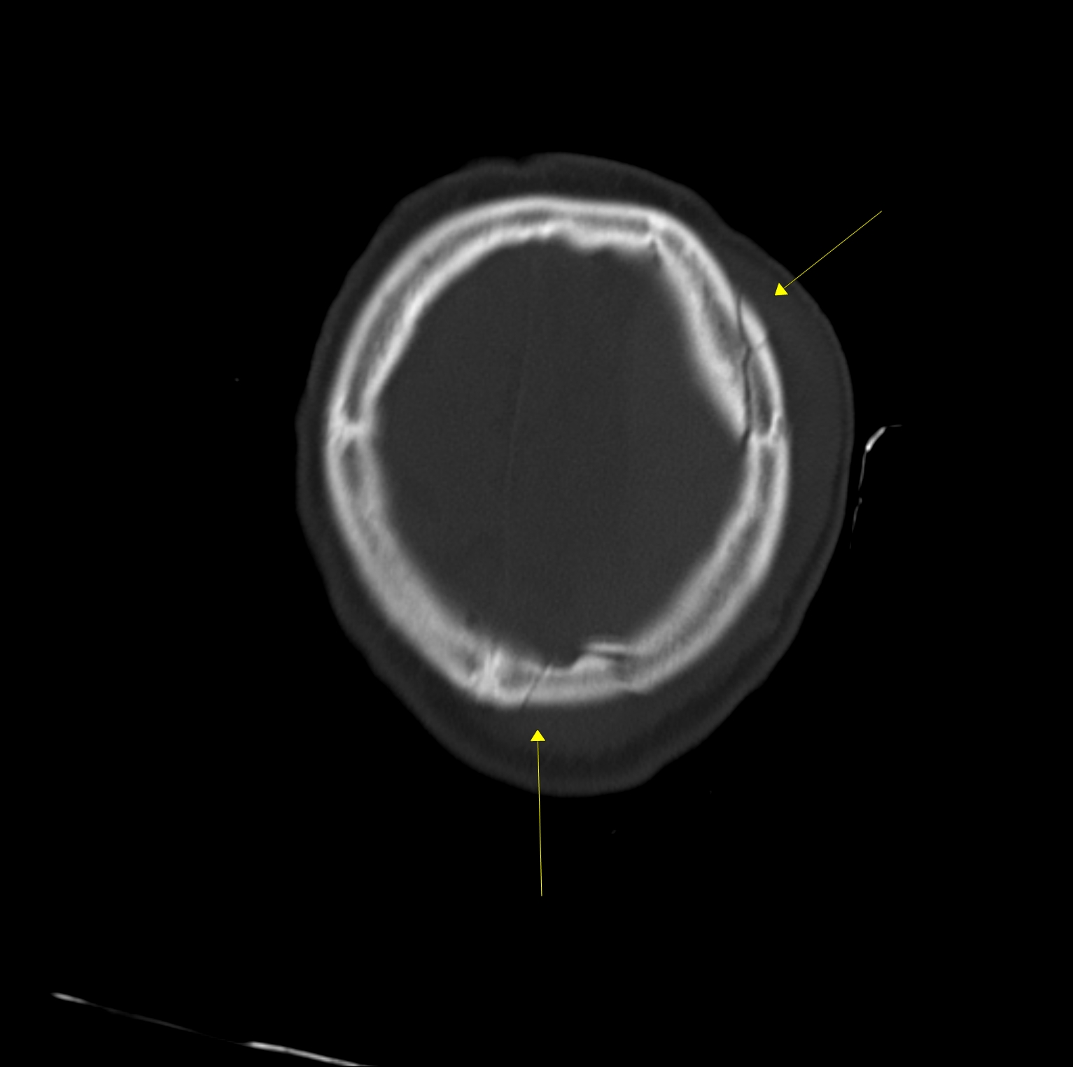 CT kostní okno axiálně - fisura kalvy