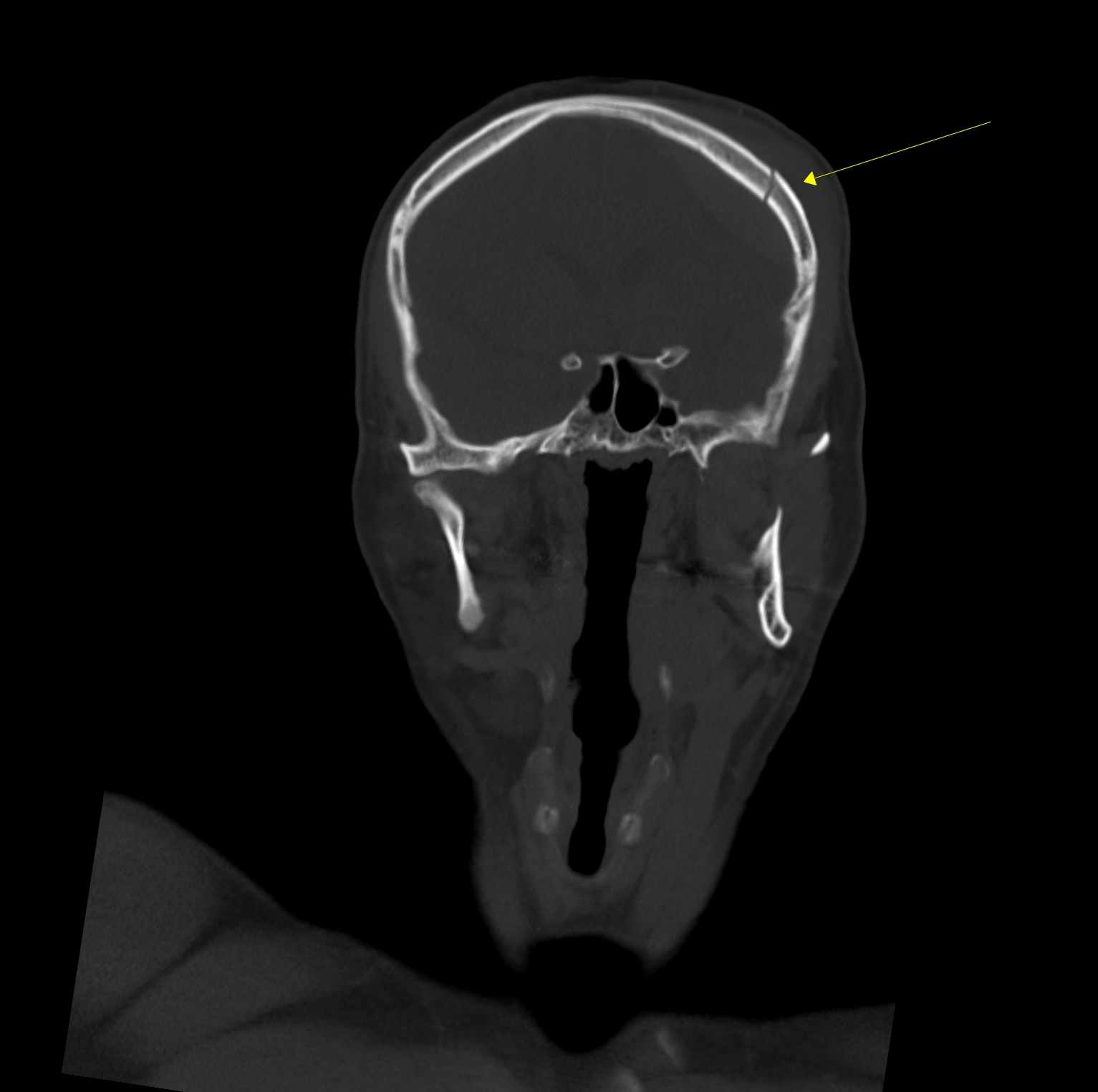 CT kostní okno koronálně - fisura kalvy