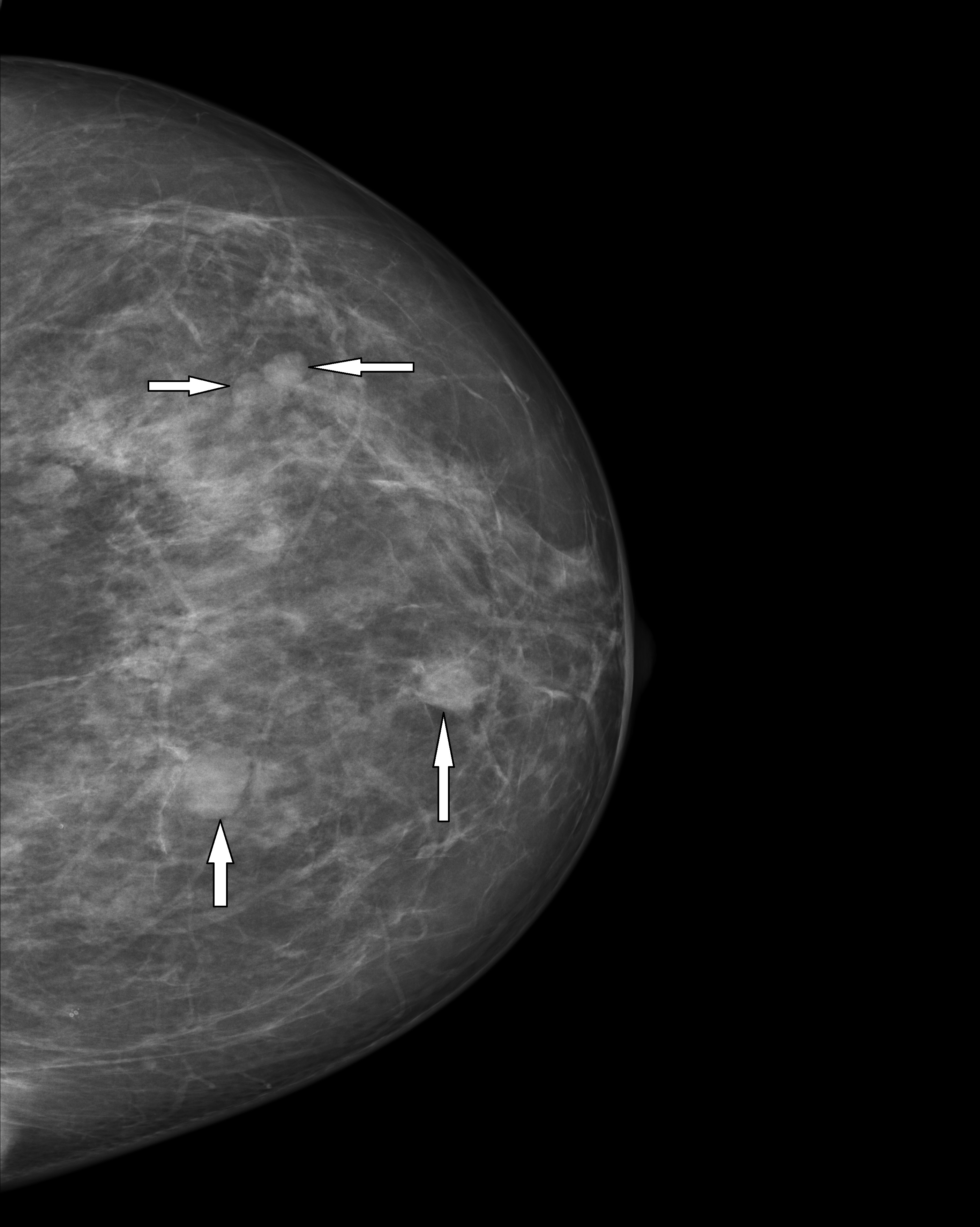 Pacientka č. 2 - Mammogram