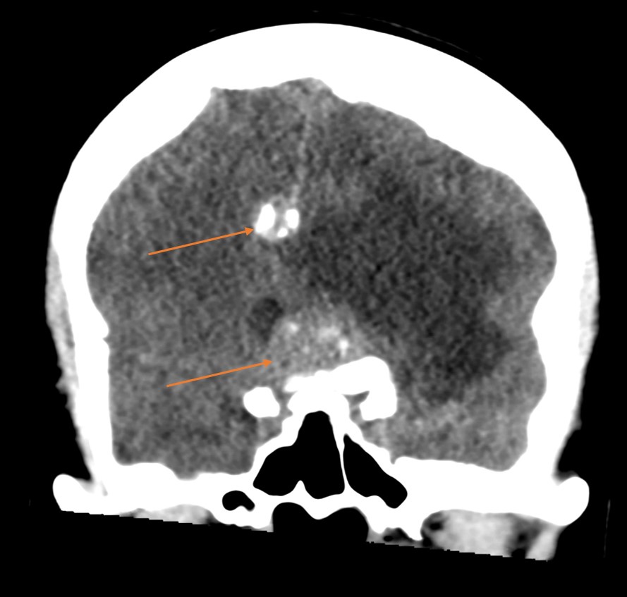 CT koronálně - expanze přední jámy, malá expanze parafalcinně vpravo, edém levého frontálního laloku