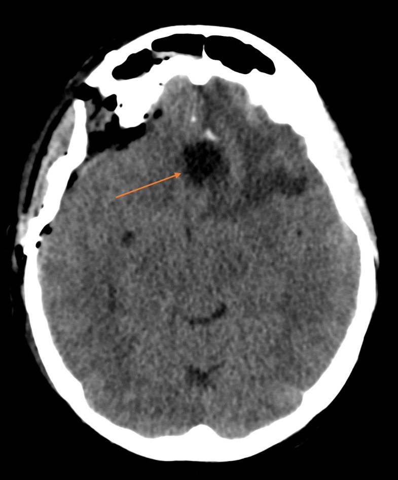 CT axiálně - pooperační defekt, nadále edém levého frontálního laloku, vpravo st.p. kraniotomii, pneumocefalus pod ploténkou