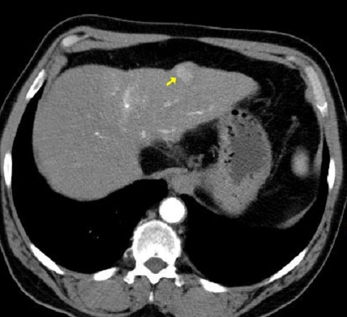 CT - arteriální fáze