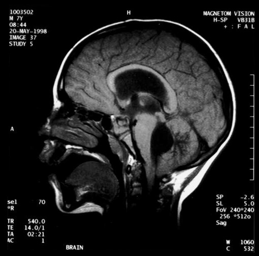 Noncommunicating obstructive hydrocephalus caused by obstruction of the foramina of Luschka and Magendie. This MRI sagittal image demonstrates dilatation of lateral ventricles with stretching of corpus callosum and dilatation of the fourth ventricle.