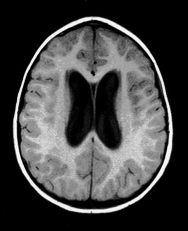 Noncommunicating obstructive hydrocephalus caused by obstruction of foramina of Luschka and Magendie. This MRI axial image demonstrates dilatation of the lateral ventricles.