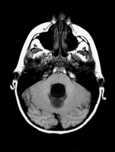 Noncommunicating obstructive hydrocephalus caused by obstruction of foramina of Luschka and Magendie. This MRI axial image demonstrates fourth ventricle dilatation.