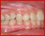 Diagnostika ortodontických anomálií na fotografiích chrupu, 2. díl