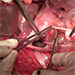 Operační léčba v onkogynekologii – karcinom hrdla, těla dělohy a ovaria
