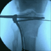 Using MIPO technique, LCP 4,5/5,0, to treat intraarticular proximal tibia fracture