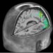 Zobrazovací metody v psychiatrii: Využití informací o morfologii mozku pro hodnocení neurobiologie duševních nemocí a klinickou praxi