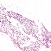 Hypoplastic acute myeloic leukemia