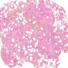 Refractory anemia with ring sideroblasts